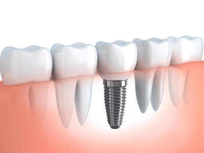 dental implants in st johns, NL